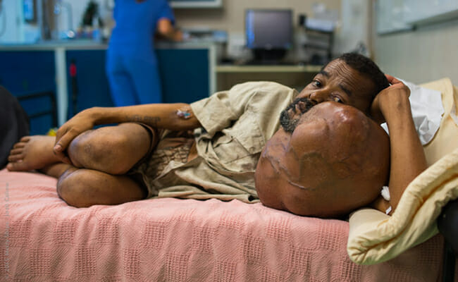 Sambany, a patient in Madagascar, came on-board the Africa Mercy to have his 16-pound tumor removed. /Courtesy Mercy Ships