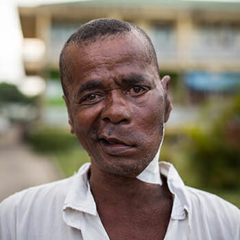 Sambany, after surgery. /Courtesy Mercy Ships